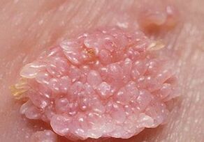 hpv rash treatment papilloma virus sintomi bocca
