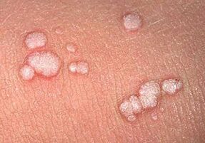 Infectia cu HPV din perspectiva dermatologului