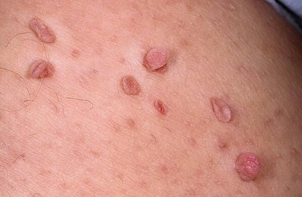 papilomele de pe piele provoacă tratament ulcerul condilomului